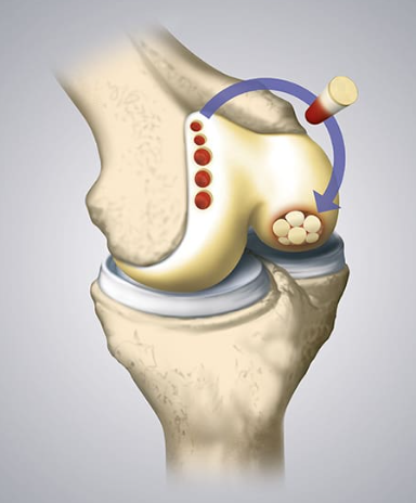 Advanced Osteochondral Autograft Transfer Treatment