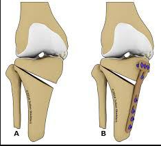 What is Knee Osteotomy Surgery?