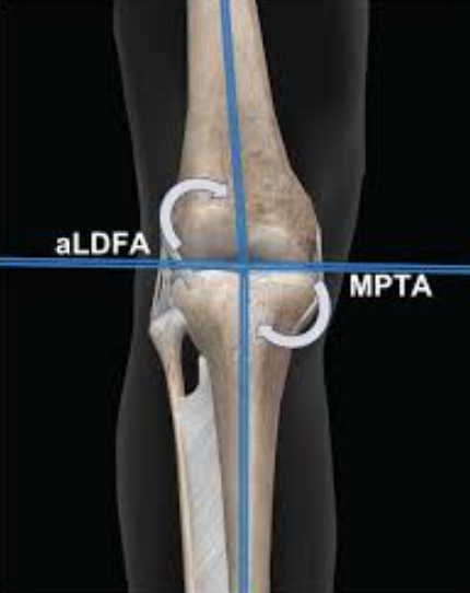 What Causes Distal Femoral Osteotomy?