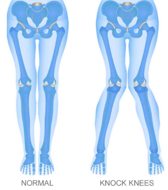 Advanced Distal Femoral Osteotomy Treatment