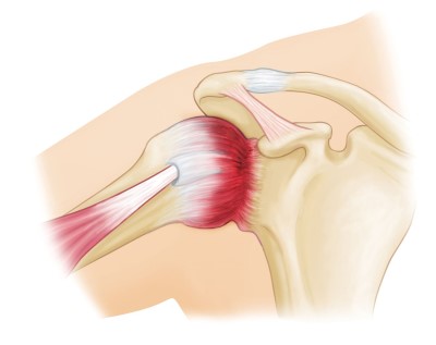 frozen-shoulder-featured-image_resize