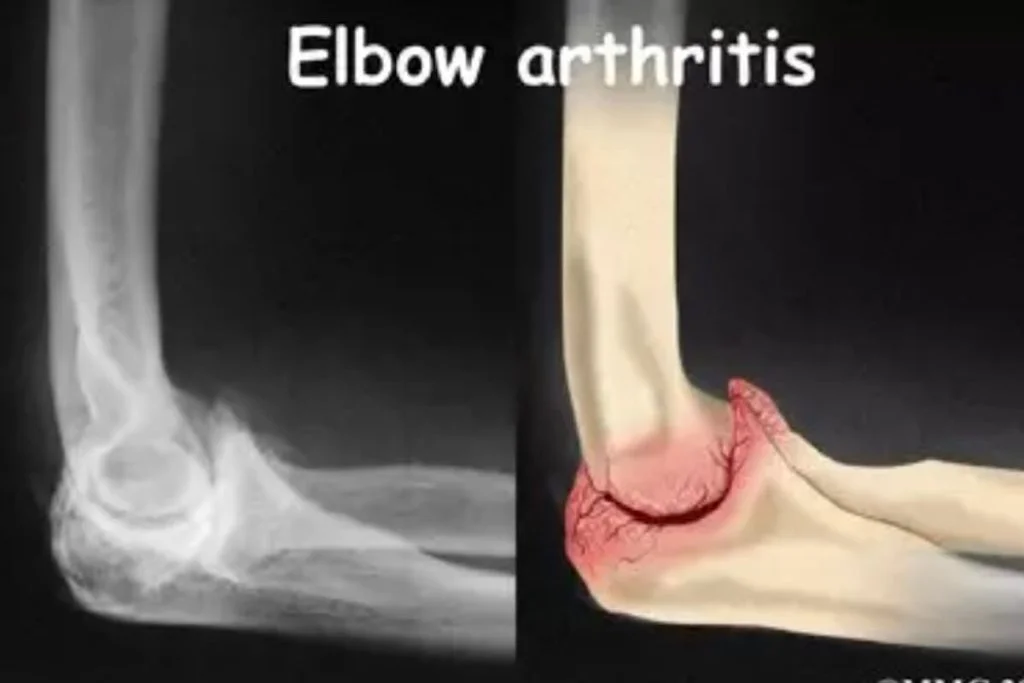 Elbow_arthritis_diagnosis