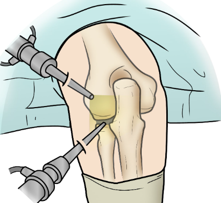 elbow-surgery