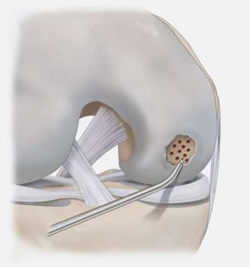 Microfracture-01