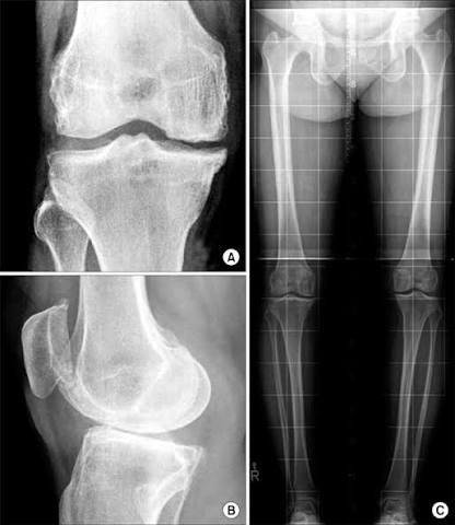 Microfracture-04